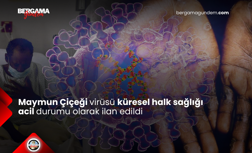 Maymun Çiçeği Virüsü Küresel Halk Sağlığı Acil Durumu Olarak İlan Edildi